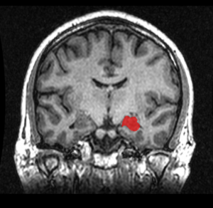 MRI_Location_Hippocampus_up.